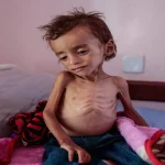 التجويع يودي بحياة 5 مواطنين بينهم طفلان خلال يوم