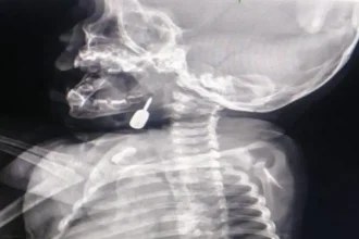 إنقاذ طفل من الاختناق