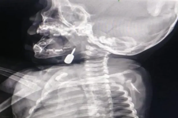 إنقاذ طفل من الاختناق