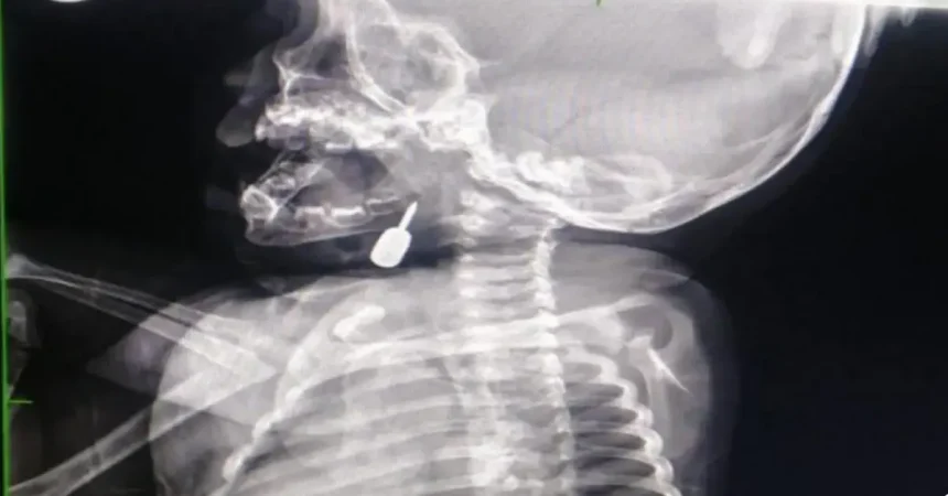 إنقاذ طفل من الاختناق